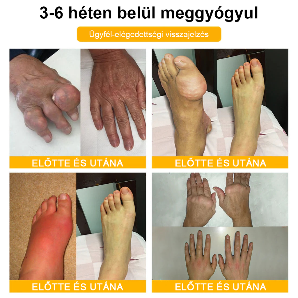 🔥Legkelendőbb丨TLOPA® Botulinum Toxin és Méhméreg Fájdalomcsillapító Csontgyógyító Krém🐝 🔥(Kifejezetten időseknek & ortopéd szakorvosok ajánlásával)🦴